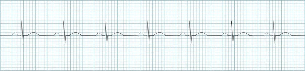 ECG-Normal-sinus-rhythm-strip