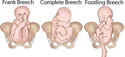 breech_grande